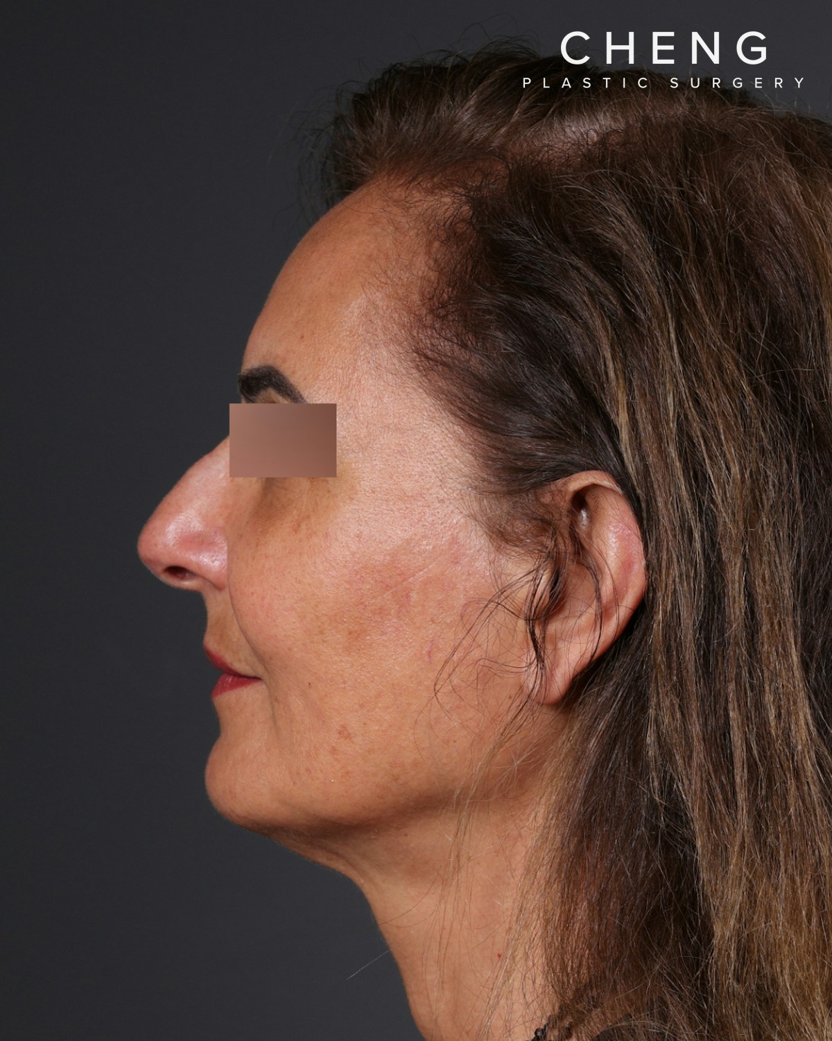 Thread Lifting Before & After Gallery - Patient 573741 - Image 10