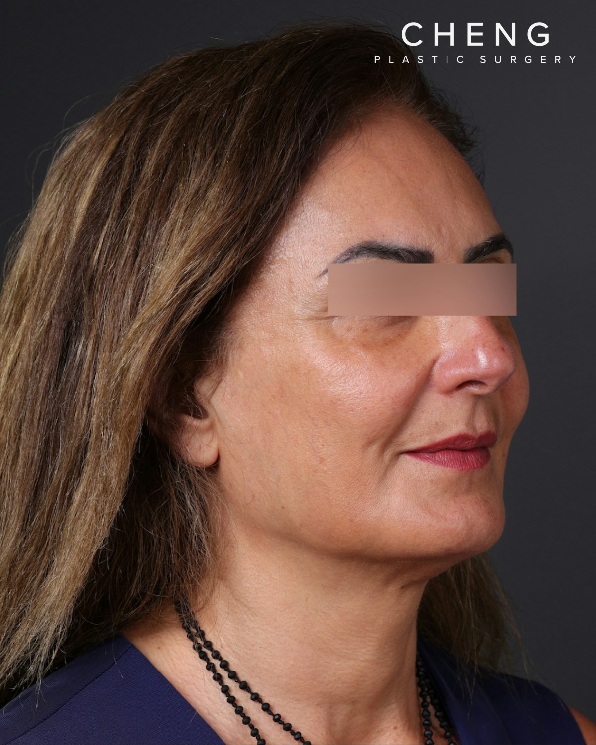 Thread Lifting Before & After Gallery - Patient 573741 - Image 4