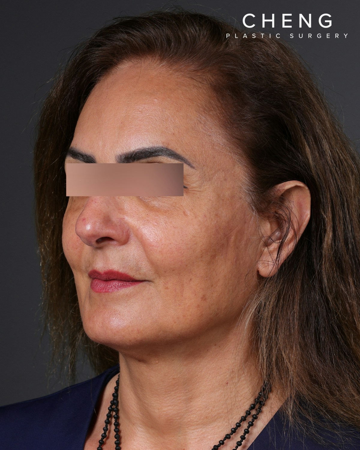 Thread Lifting Before & After Gallery - Patient 573741 - Image 8