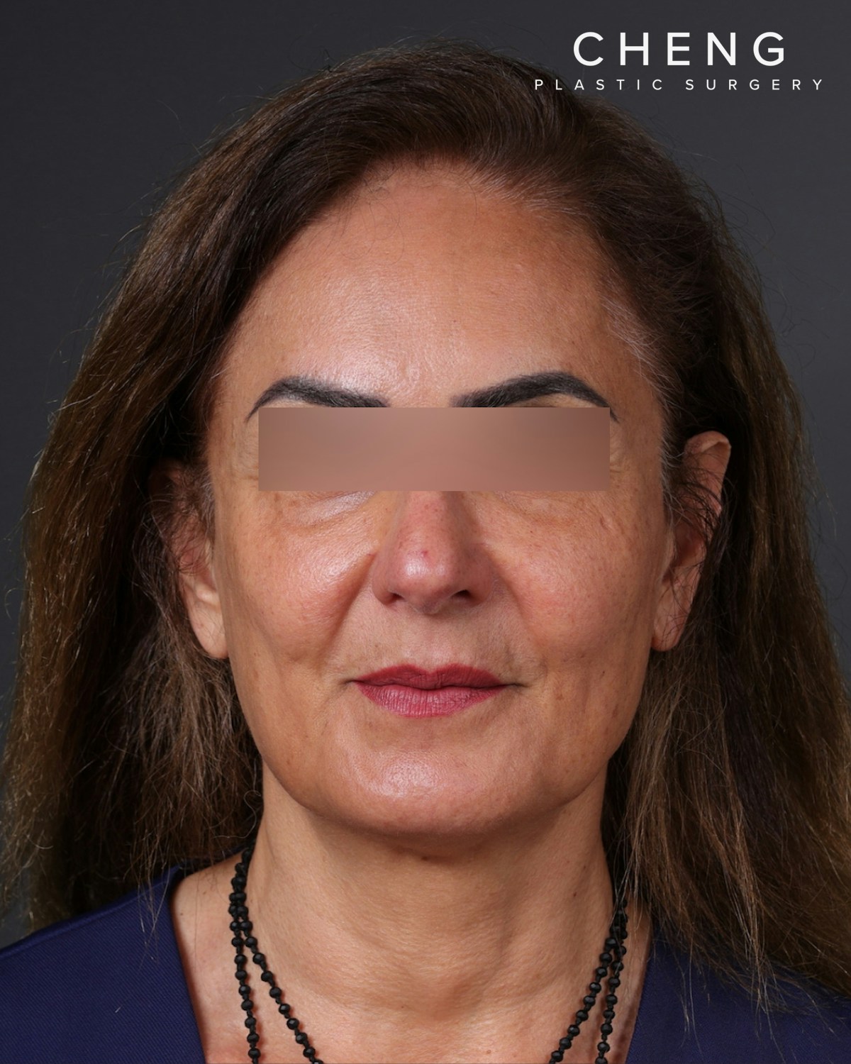 Thread Lifting Before & After Gallery - Patient 573741 - Image 2
