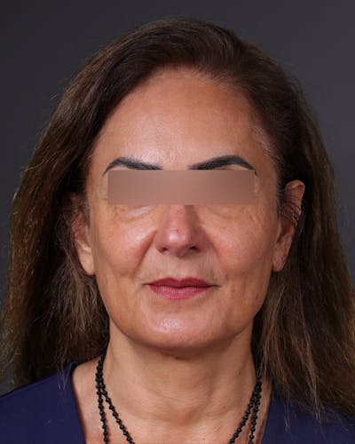 Thread Lifting Before & After Gallery - Patient 573741 - Image 2