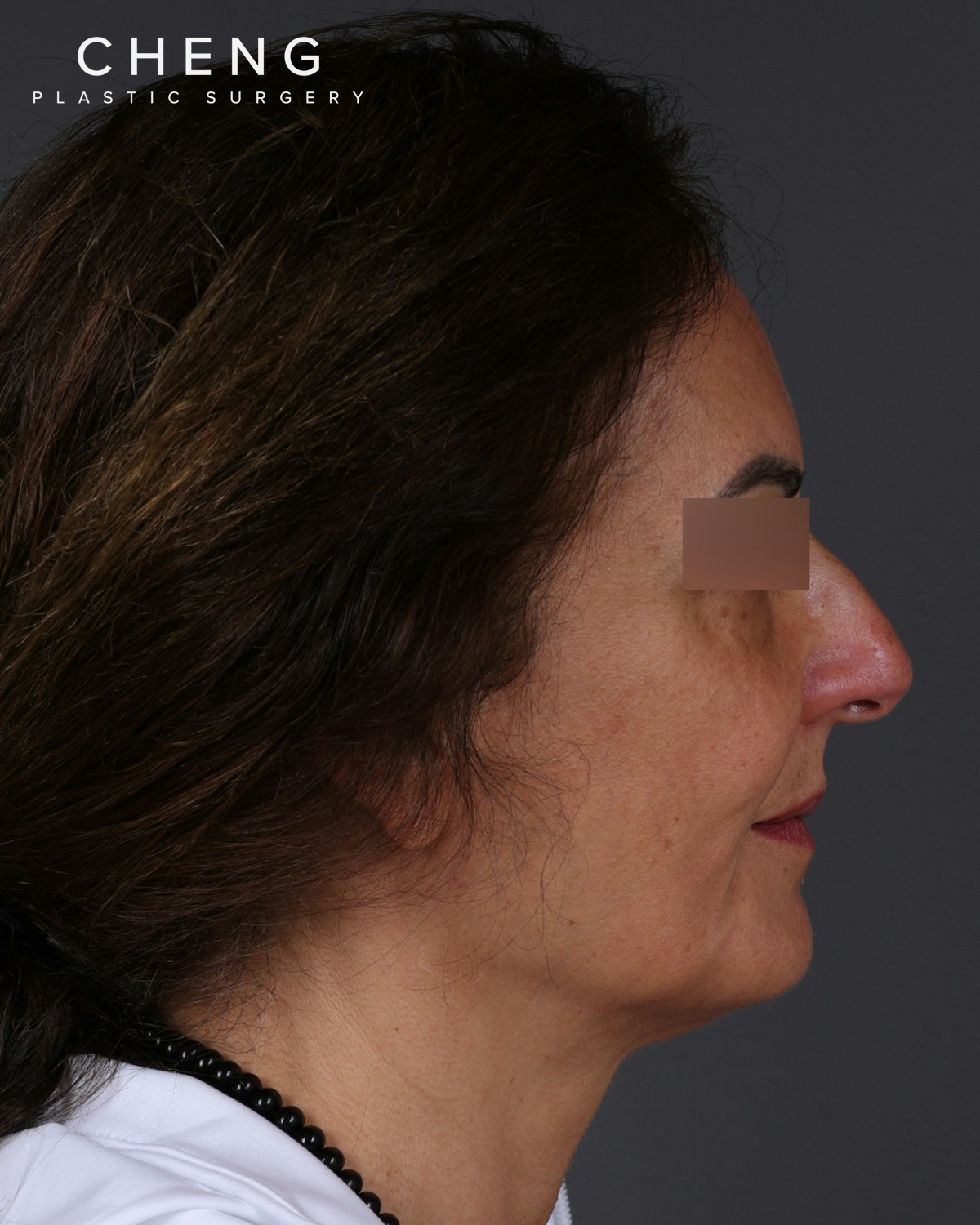 Thread Lifting Before & After Gallery - Patient 573741 - Image 5