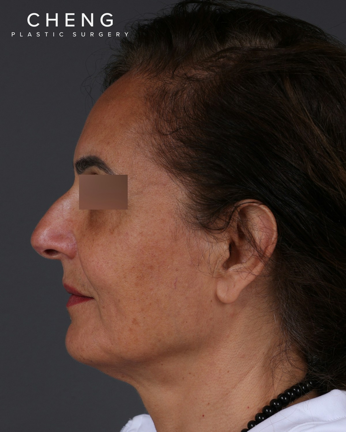 Thread Lifting Before & After Gallery - Patient 573741 - Image 9