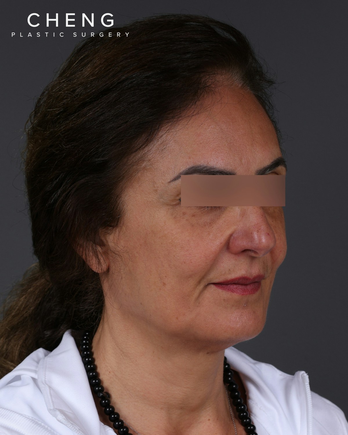 Thread Lifting Before & After Gallery - Patient 573741 - Image 3