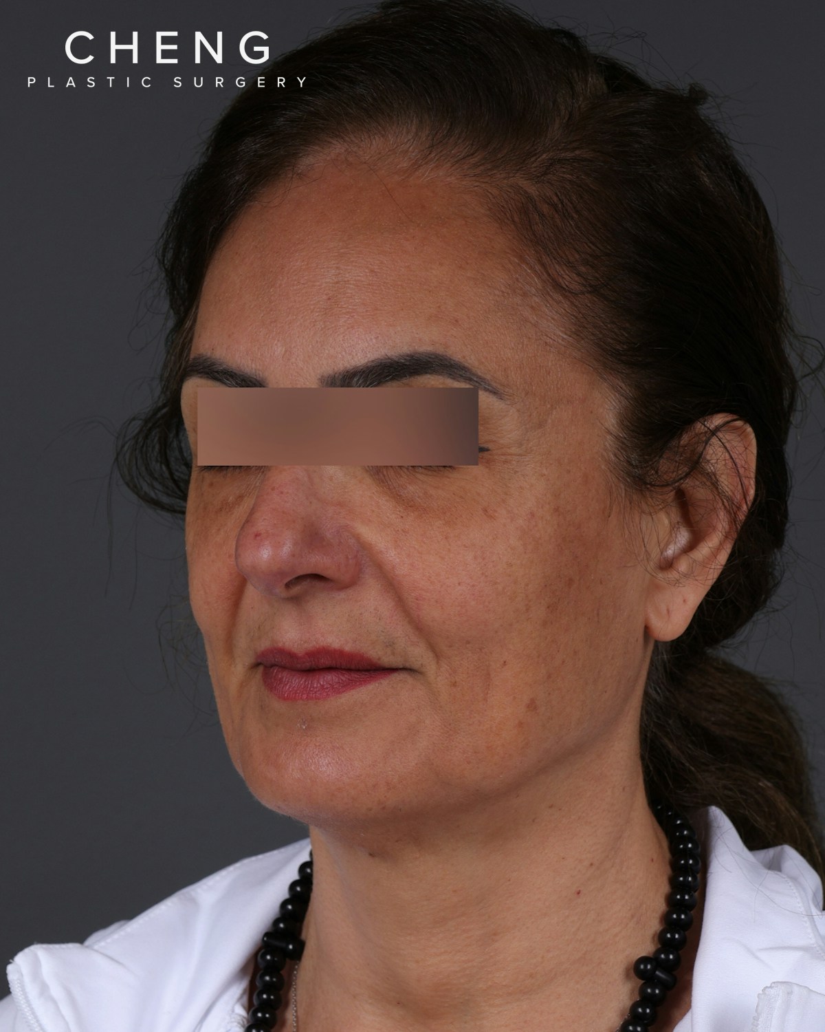 Thread Lifting Before & After Gallery - Patient 573741 - Image 7