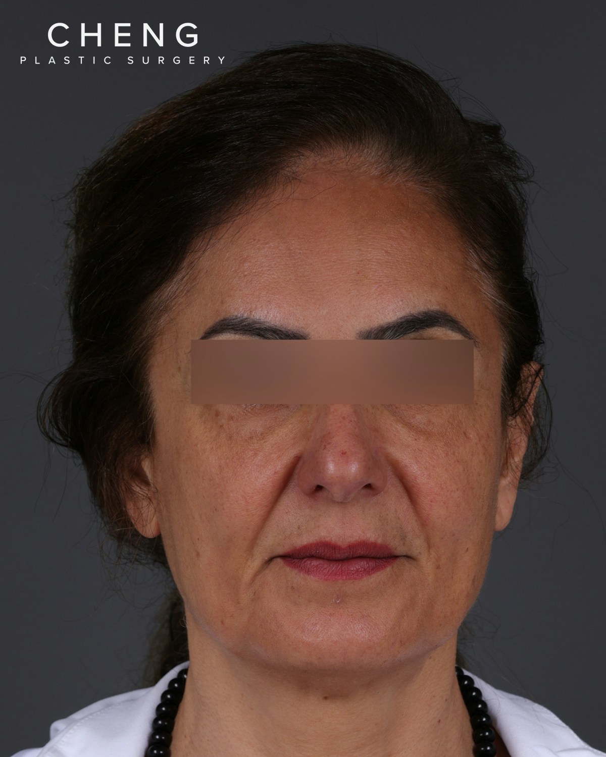 Thread Lifting Before & After Gallery - Patient 573741 - Image 1