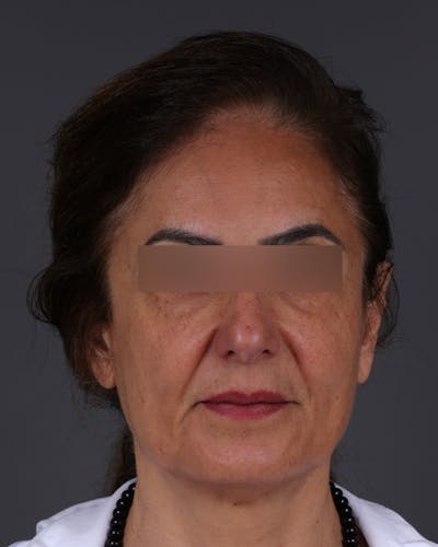Thread Lifting Before & After Gallery - Patient 573741 - Image 1