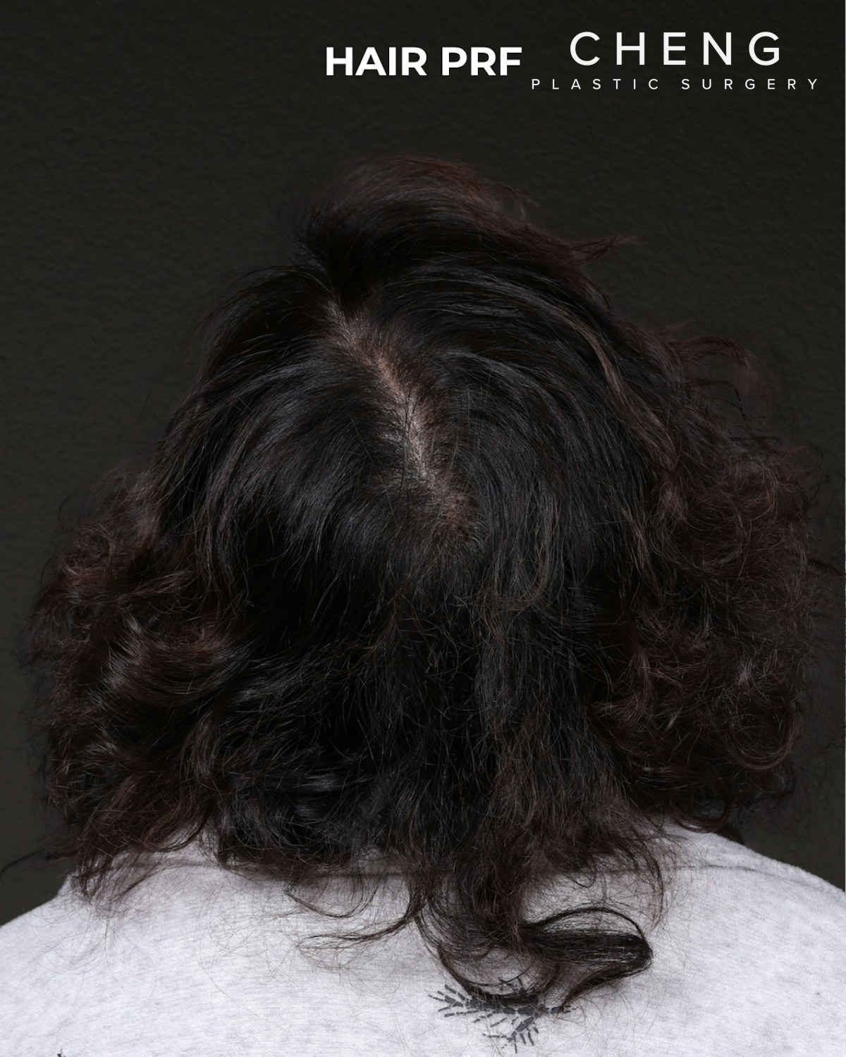 Hair Rejuvenation With PRP Before & After Gallery - Patient 118949 - Image 2