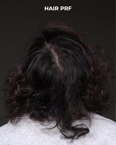 Hair Rejuvenation With PRP Before & After Gallery - Patient 118949 - Image 2
