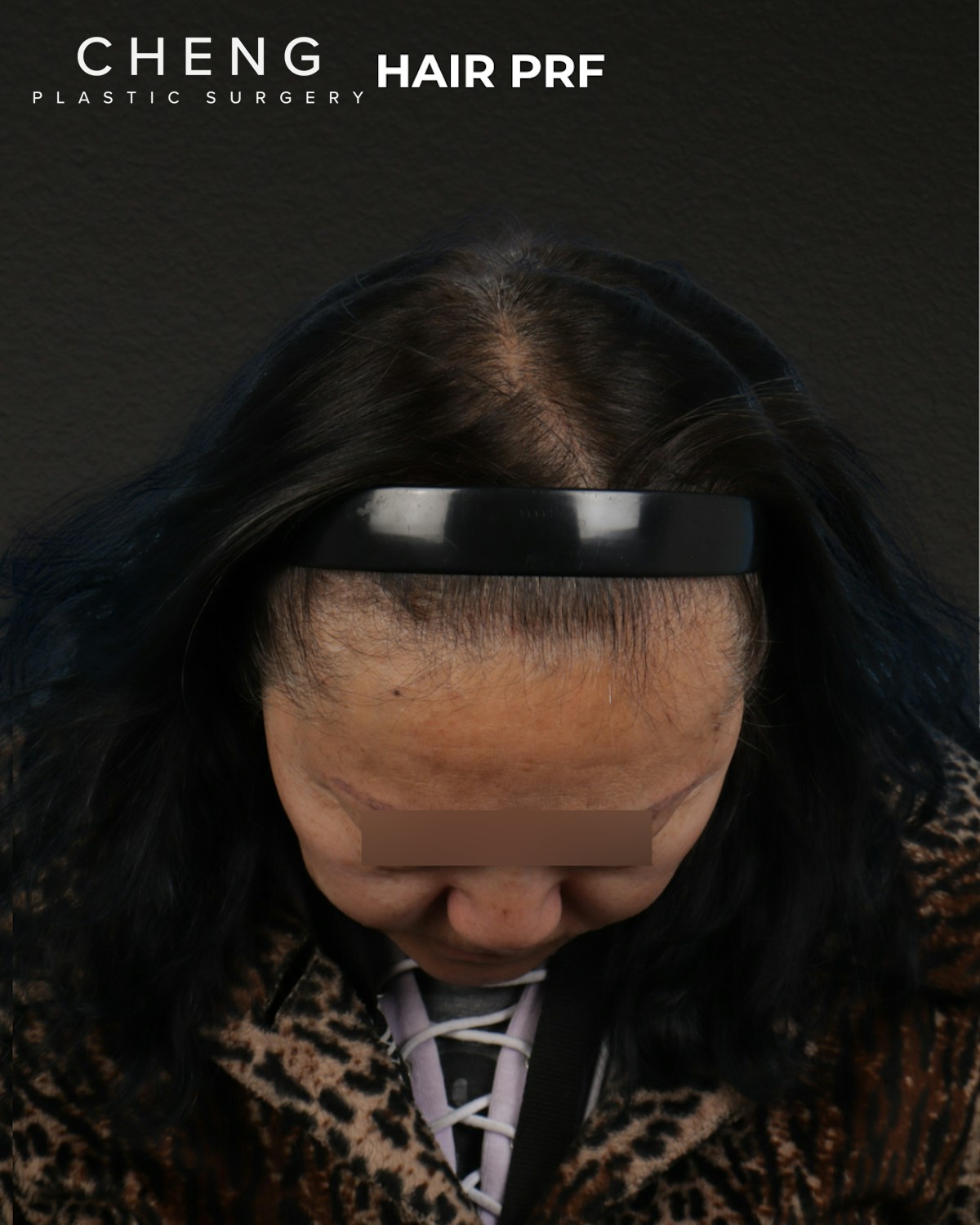 Hair Rejuvenation With PRP Before & After Gallery - Patient 118949 - Image 3