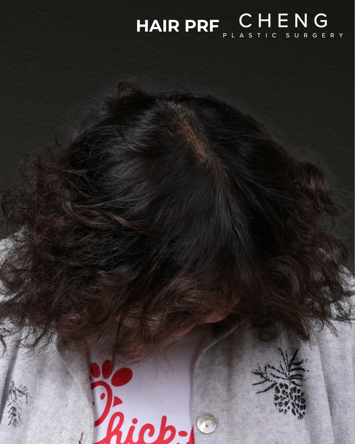 Hair Rejuvenation With PRP Before & After Gallery - Patient 118949 - Image 4