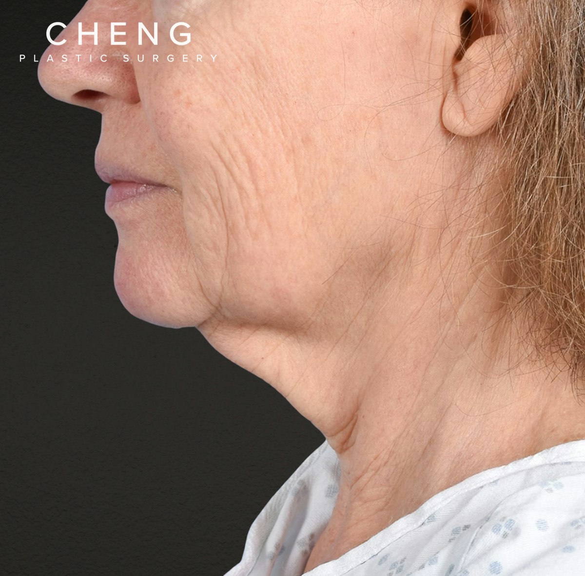 Neck Lift Before & After Gallery - Patient 328488 - Image 1