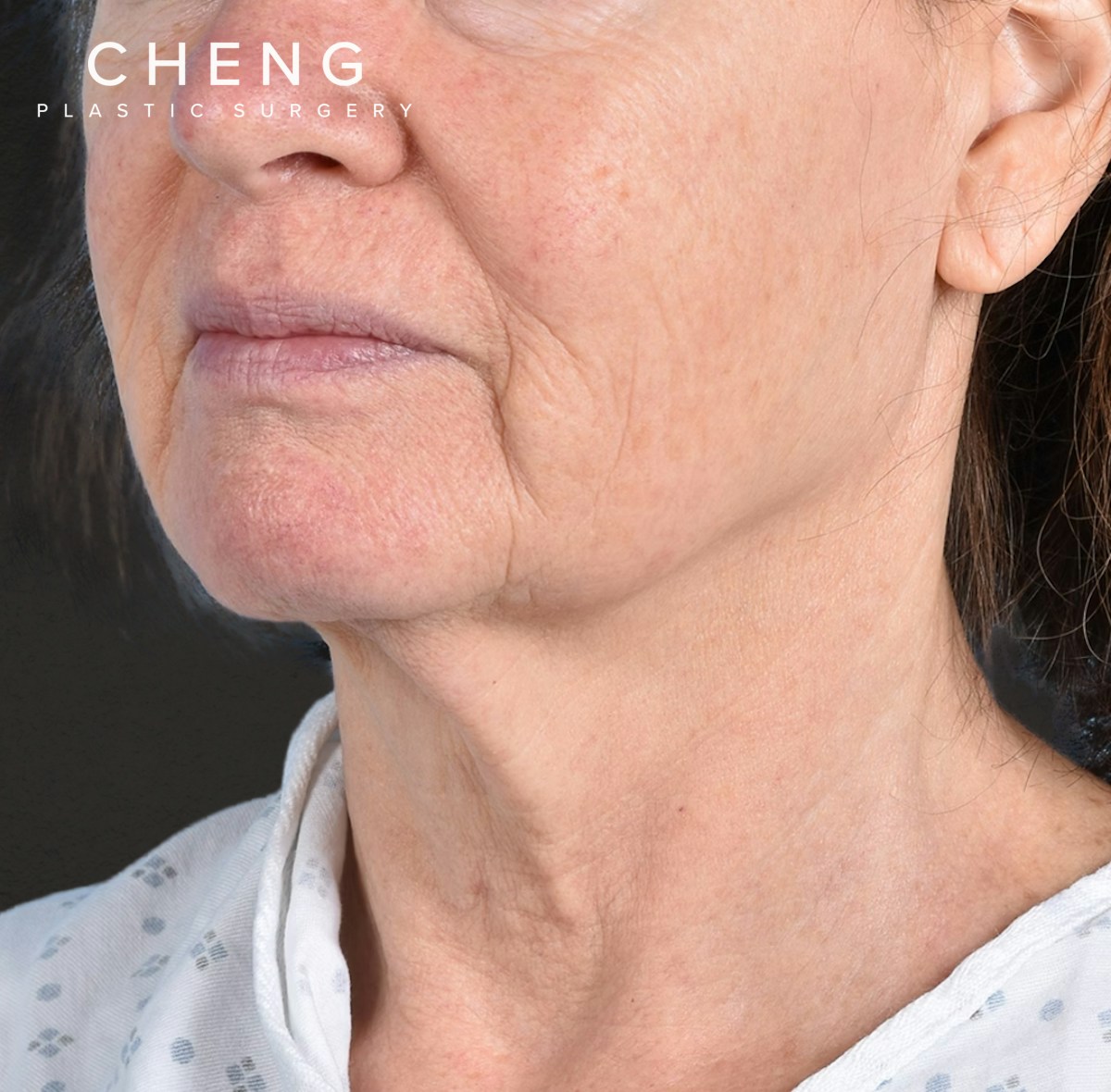 Neck Lift Before & After Gallery - Patient 328488 - Image 3