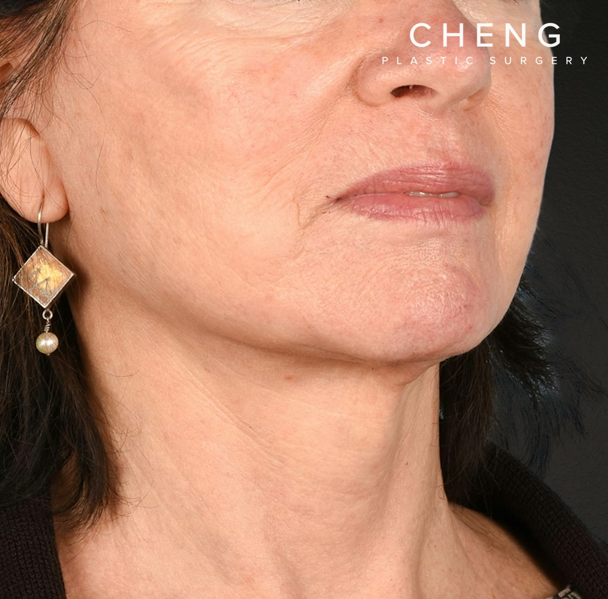 Neck Lift Before & After Gallery - Patient 328488 - Image 6
