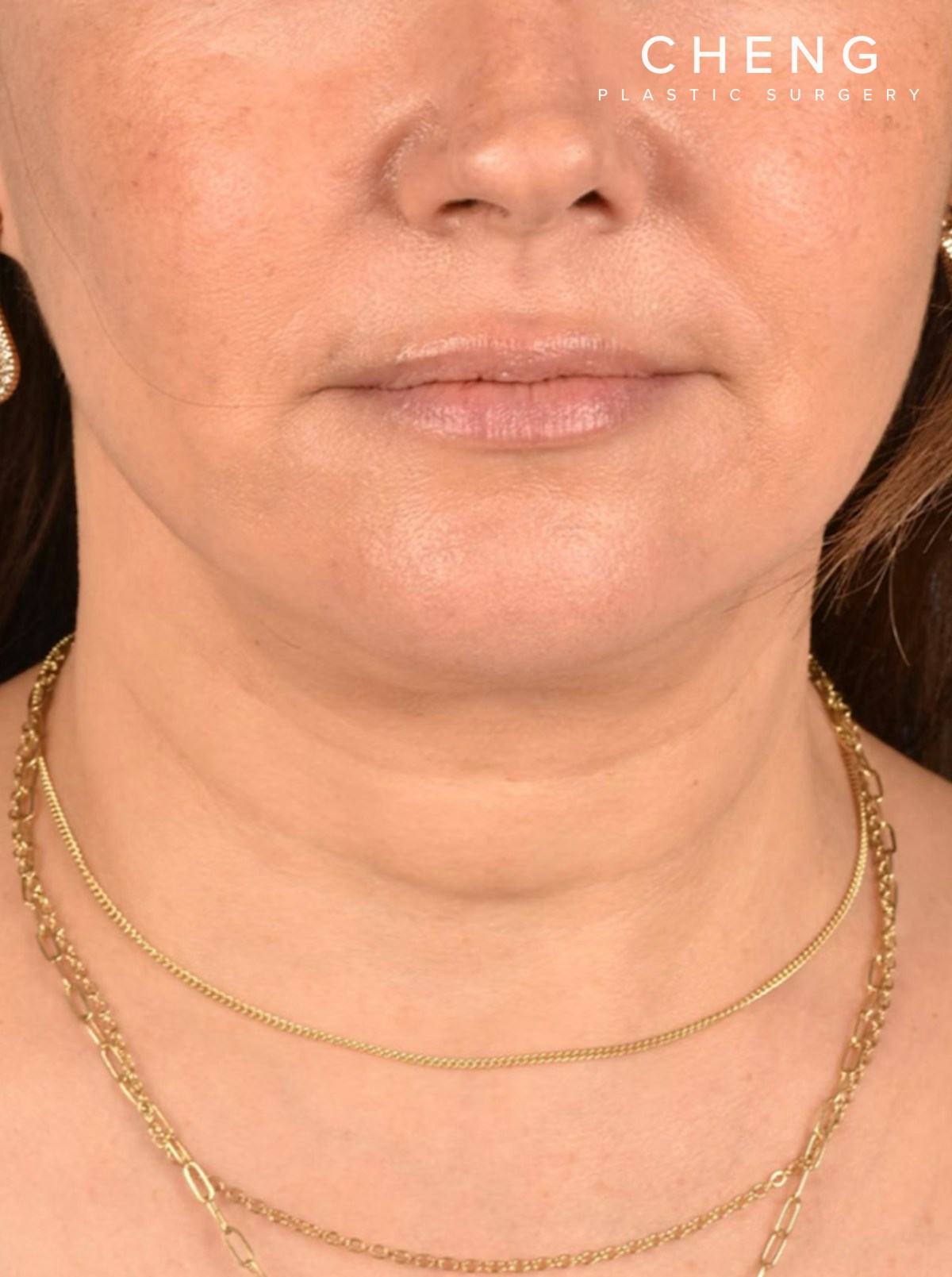 Neck Lift Before & After Gallery - Patient 382090 - Image 2