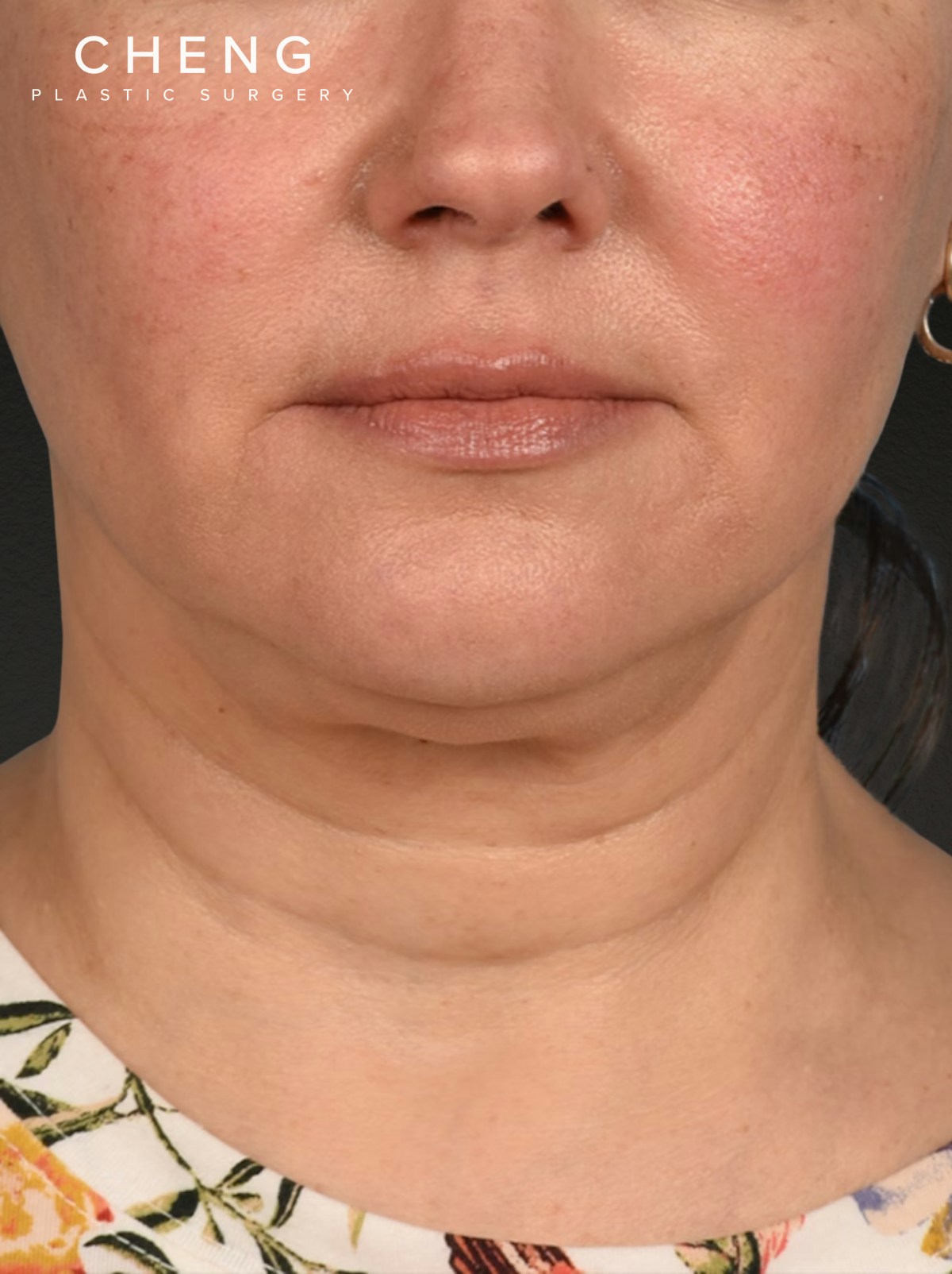 Neck Lift Before & After Gallery - Patient 382090 - Image 1