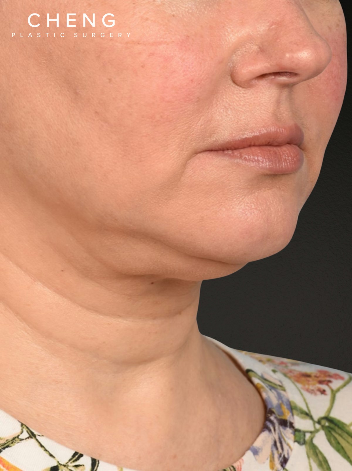 Neck Lift Before & After Gallery - Patient 382090 - Image 3
