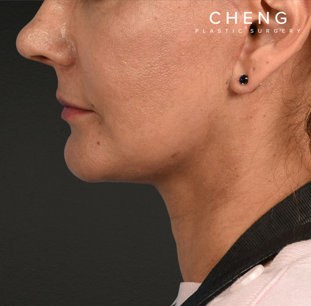 Neck Lift Before & After Gallery - Patient 424030 - Image 8