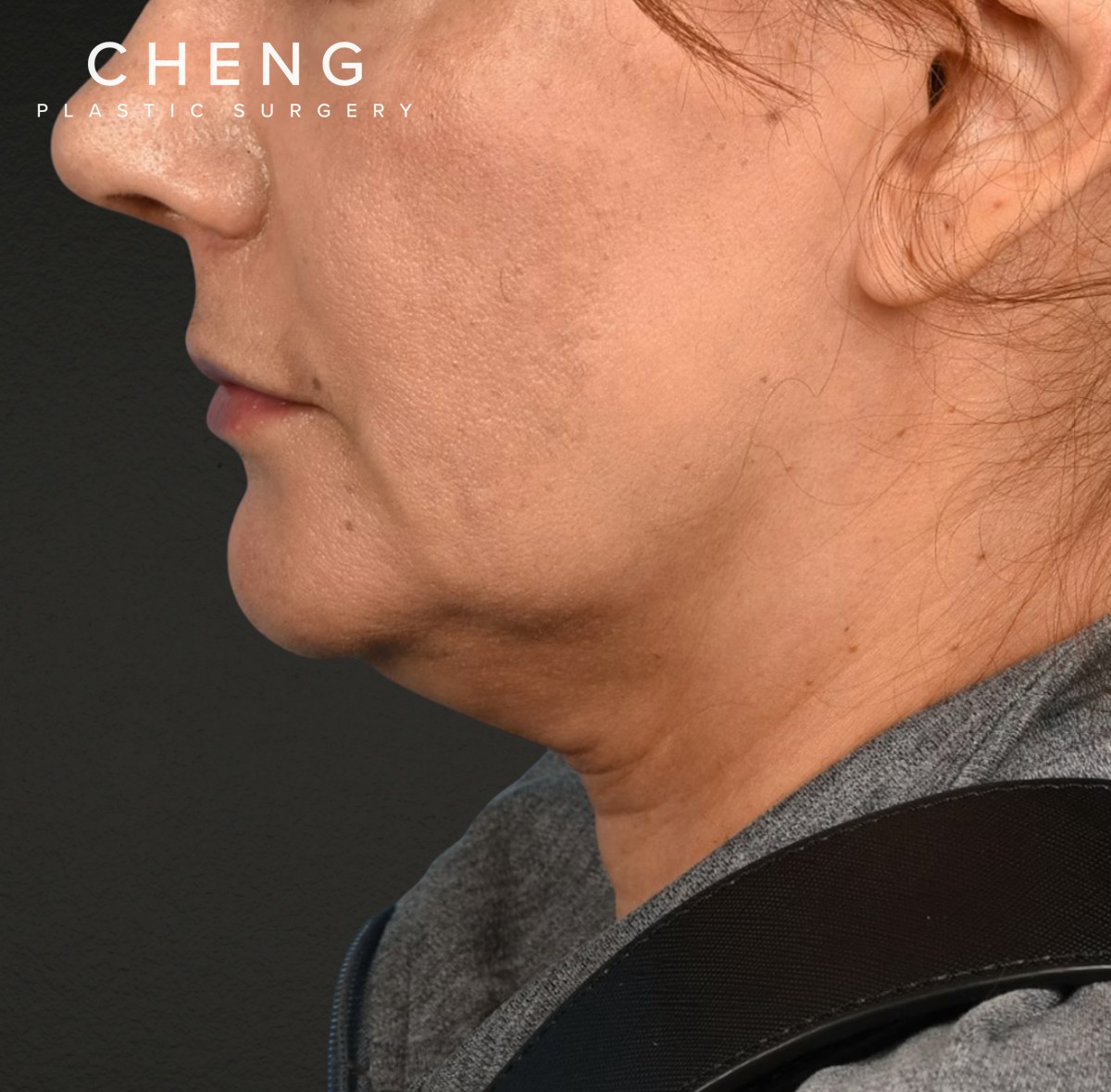 Neck Lift Before & After Gallery - Patient 424030 - Image 7