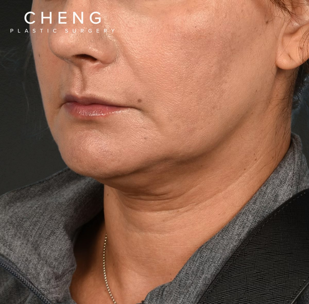Neck Lift Before & After Gallery - Patient 424030 - Image 5