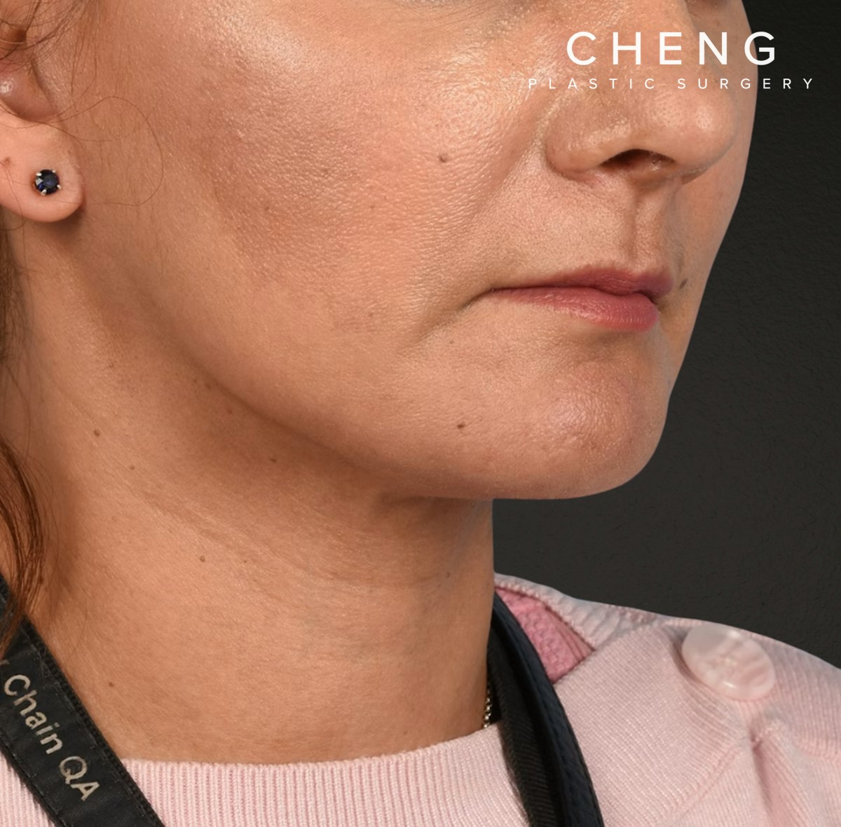 Neck Lift Before & After Gallery - Patient 424030 - Image 4