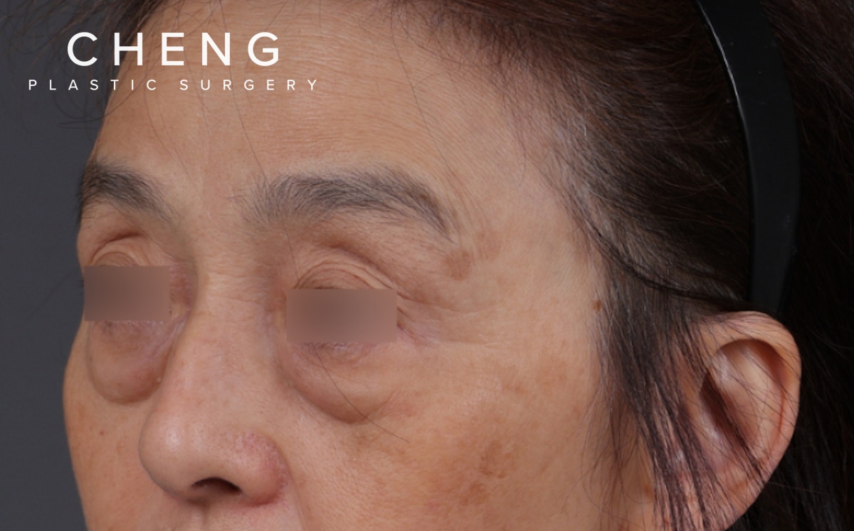 Blepharoplasty Before & After Gallery - Patient 189111 - Image 1