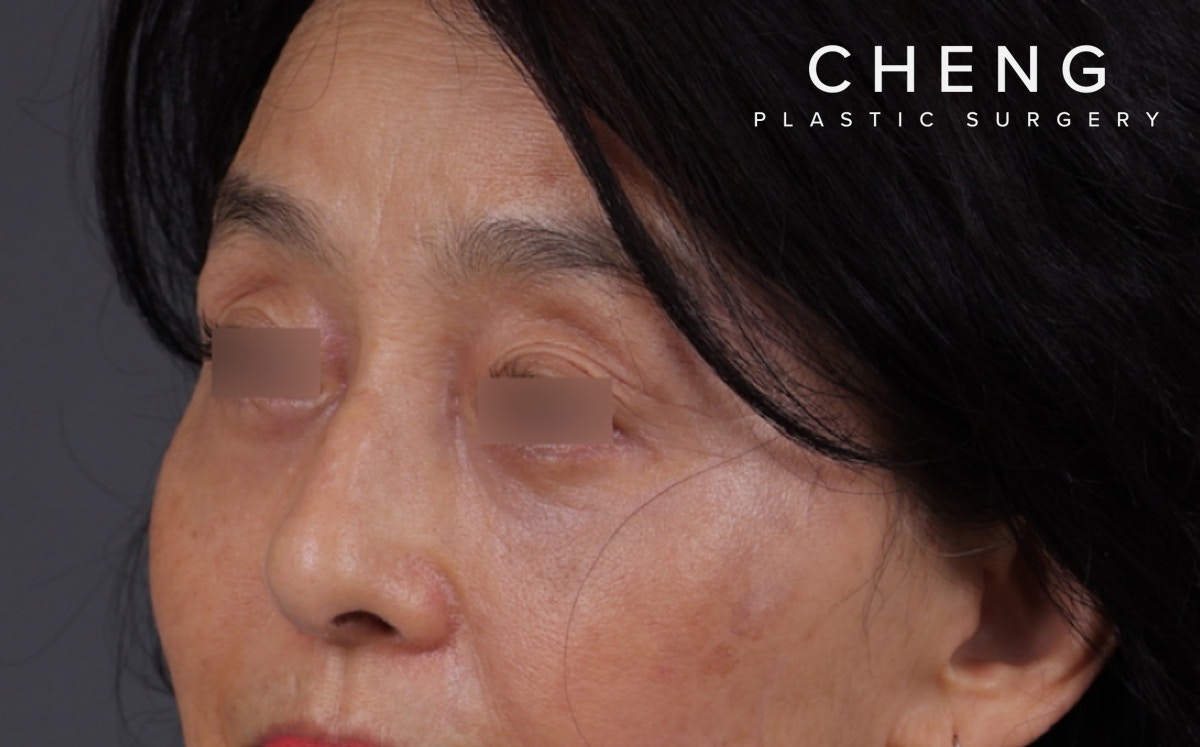 Blepharoplasty Before & After Gallery - Patient 189111 - Image 2