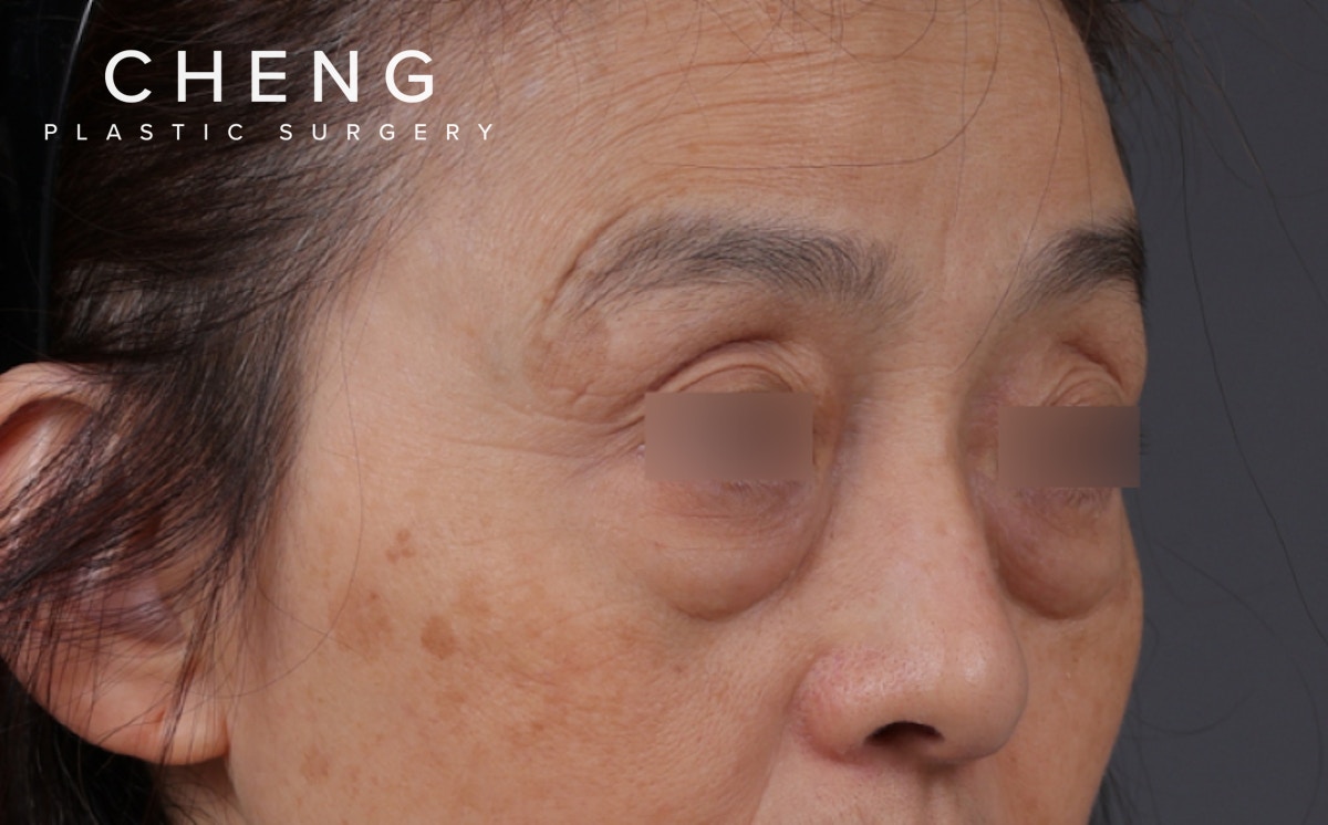 Blepharoplasty Before & After Gallery - Patient 189111 - Image 3
