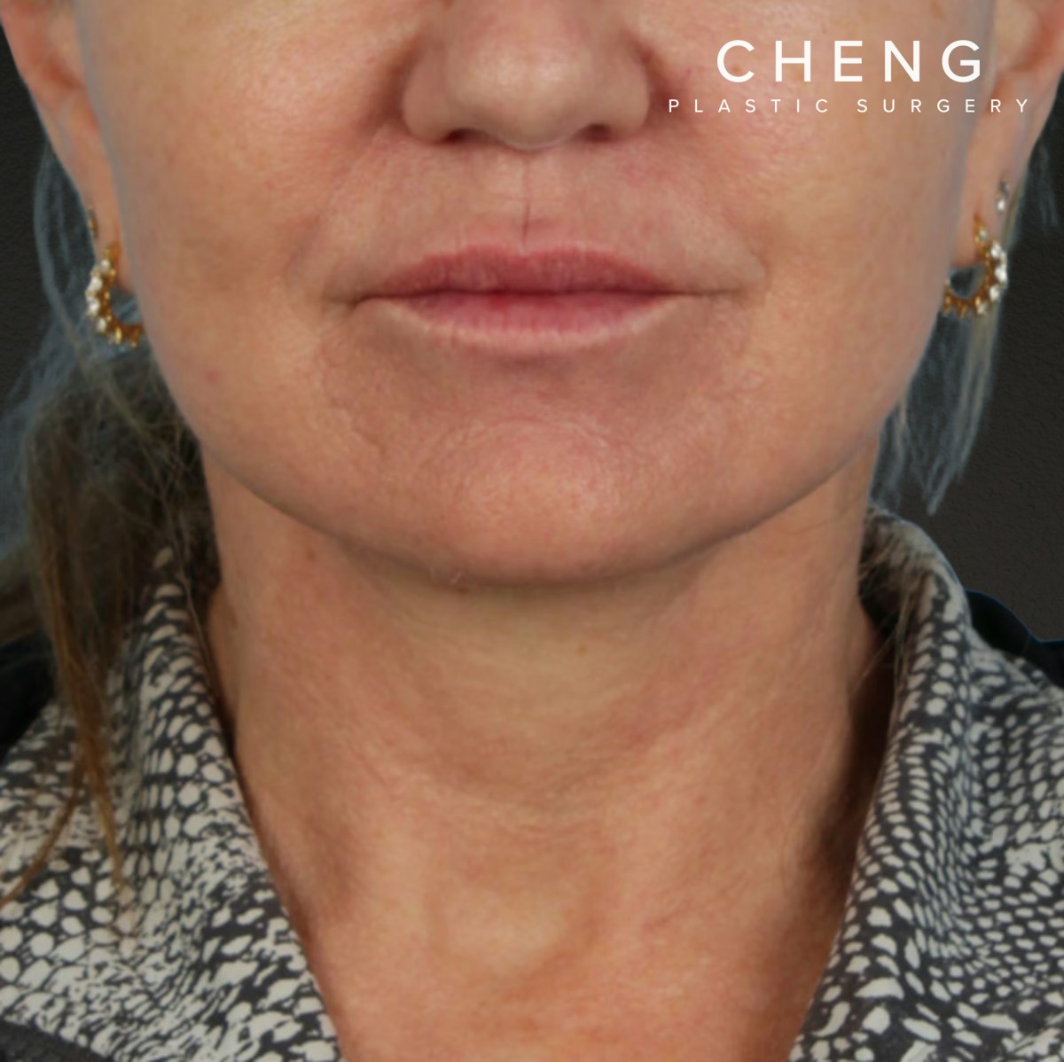 Neck Lift Before & After Gallery - Patient 278784 - Image 2