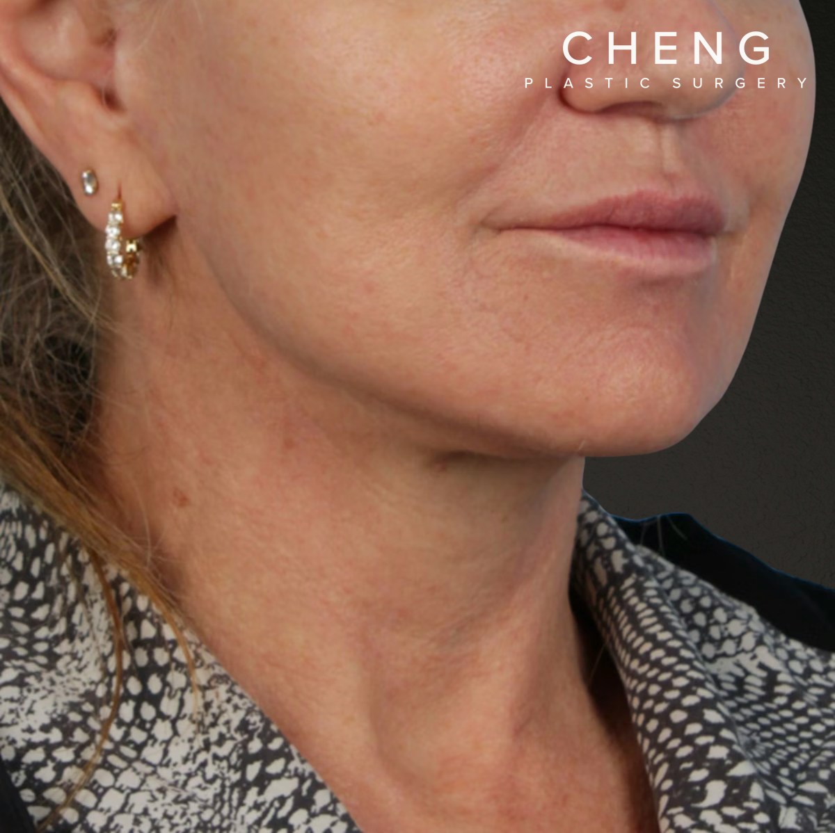 Neck Lift Before & After Gallery - Patient 278784 - Image 8