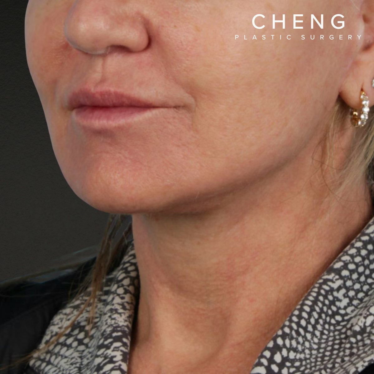 Neck Lift Before & After Gallery - Patient 278784 - Image 4