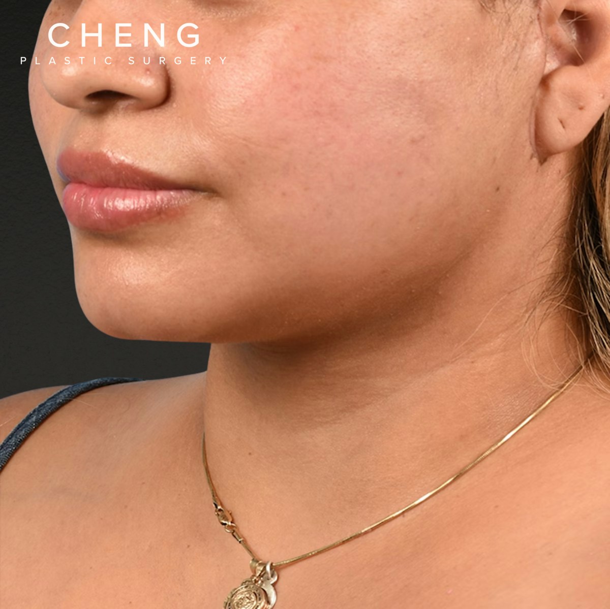 Neck Lift Before & After Gallery - Patient 776486 - Image 1