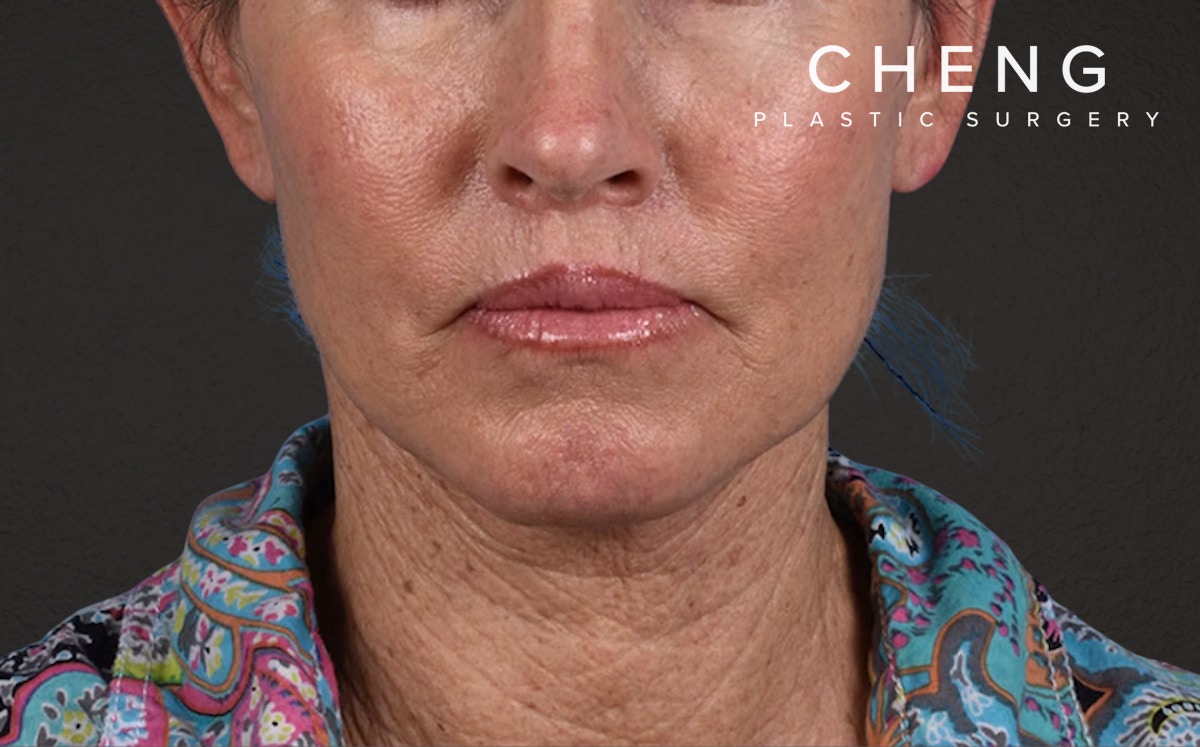 Neck Lift Before & After Gallery - Patient 540880 - Image 2