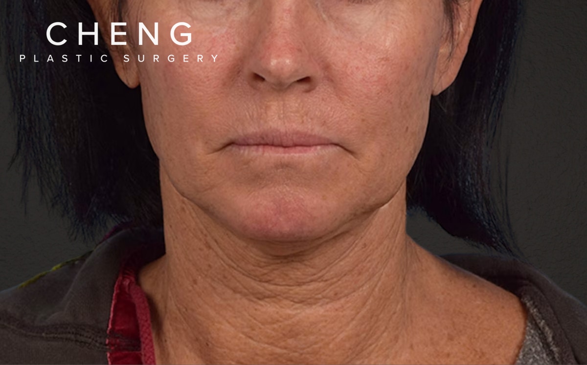 Neck Lift Before & After Gallery - Patient 540880 - Image 1