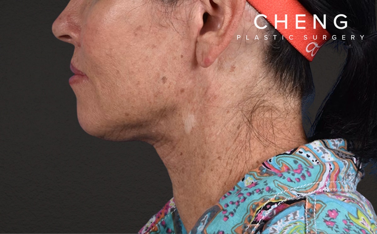 Neck Lift Before & After Gallery - Patient 540880 - Image 6