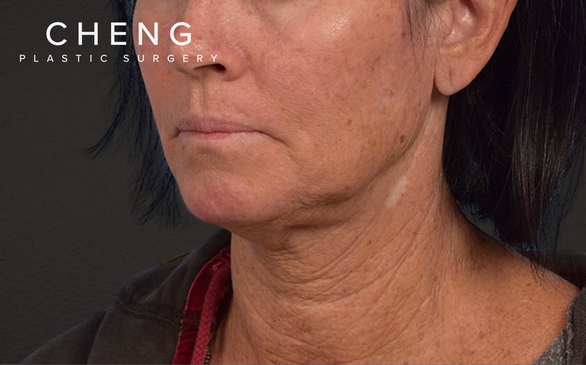 Neck Lift Before & After Gallery - Patient 540880 - Image 3