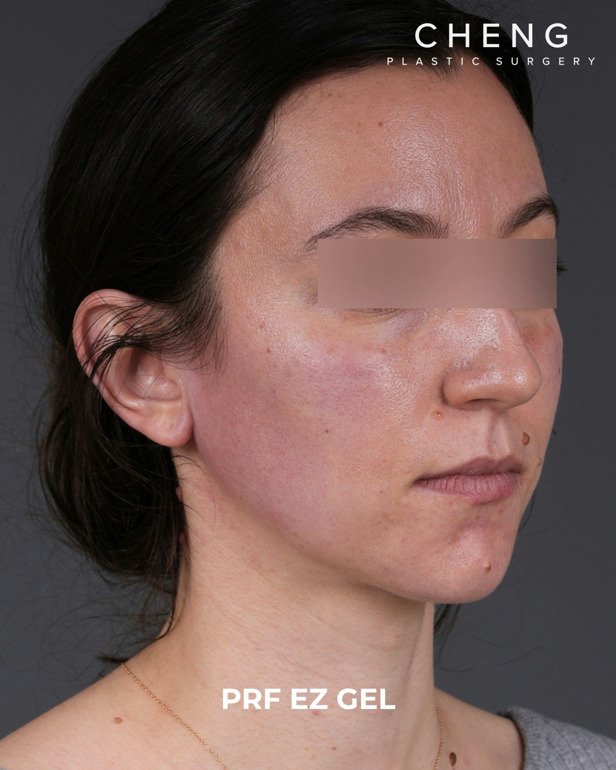 PRF Before & After Gallery - Patient 856119 - Image 4