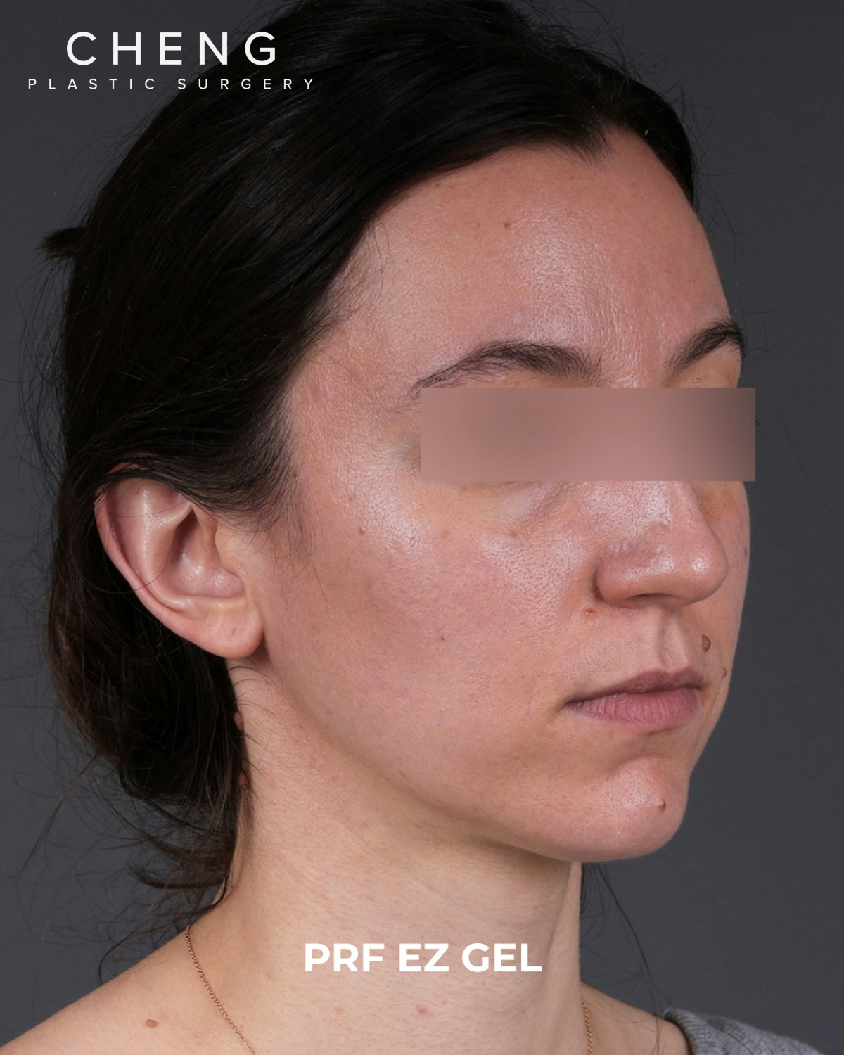 PRF Before & After Gallery - Patient 856119 - Image 3