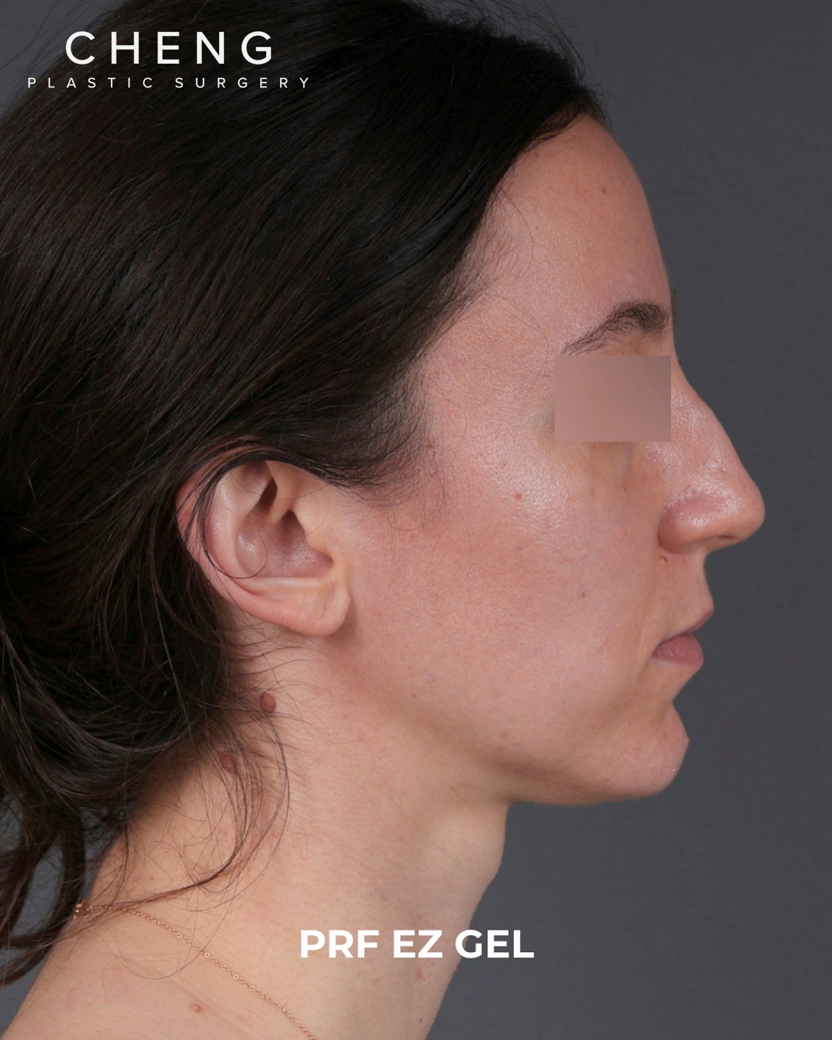 PRF Before & After Gallery - Patient 856119 - Image 5
