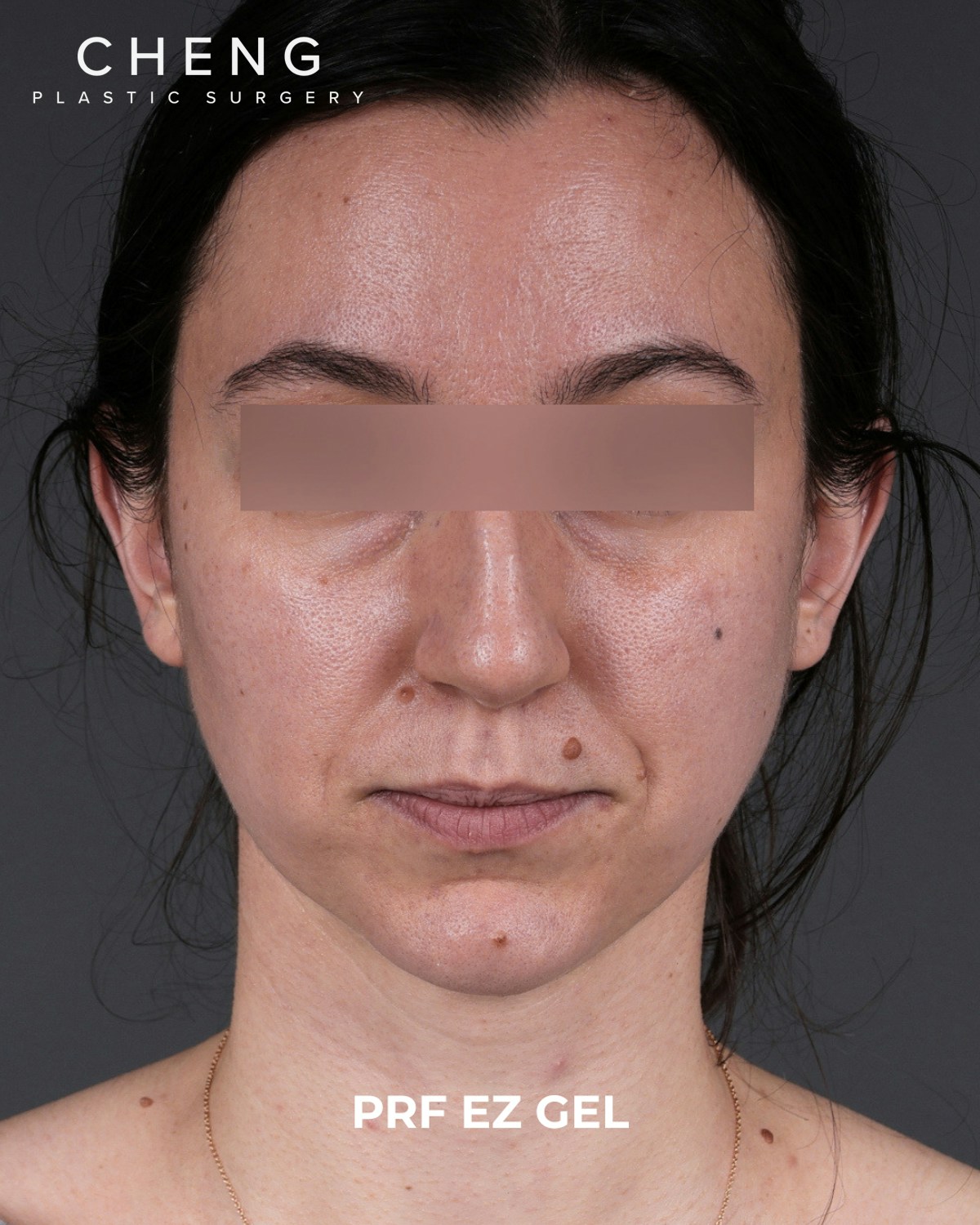 PRF Before & After Gallery - Patient 856119 - Image 1