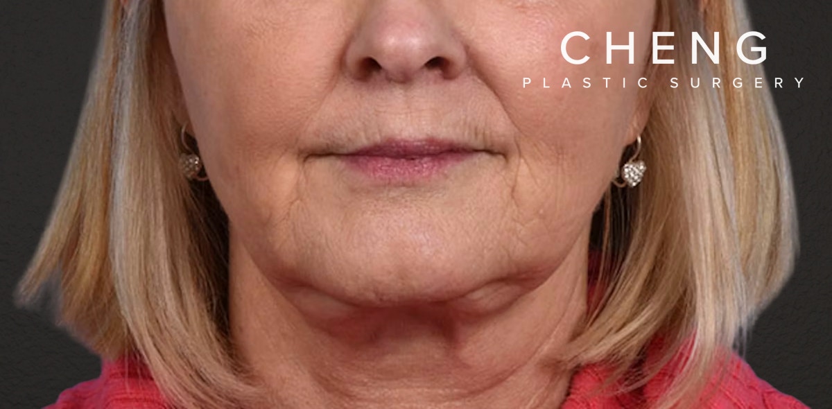Neck Lift Before & After Gallery - Patient 350287 - Image 2