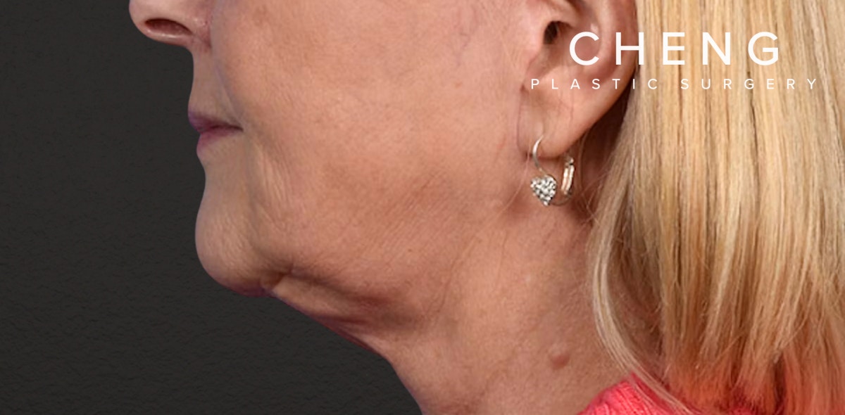 Neck Lift Before & After Gallery - Patient 350287 - Image 6