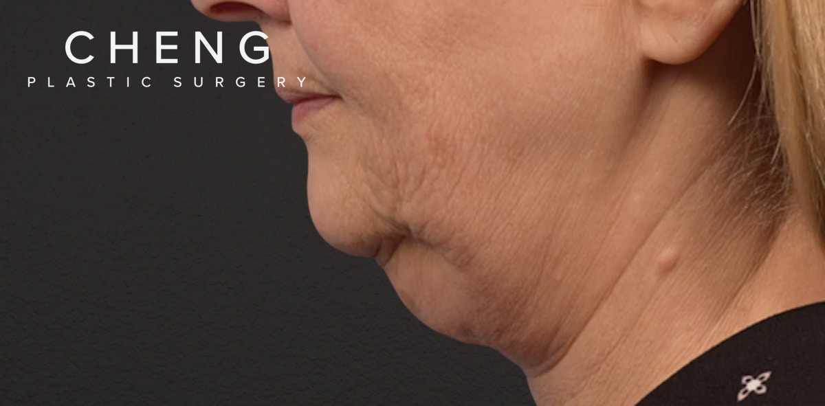 Neck Lift Before & After Gallery - Patient 350287 - Image 5