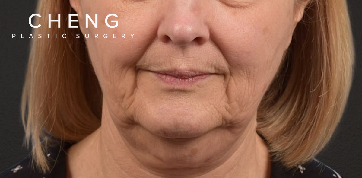 Neck Lift Before & After Gallery - Patient 350287 - Image 1