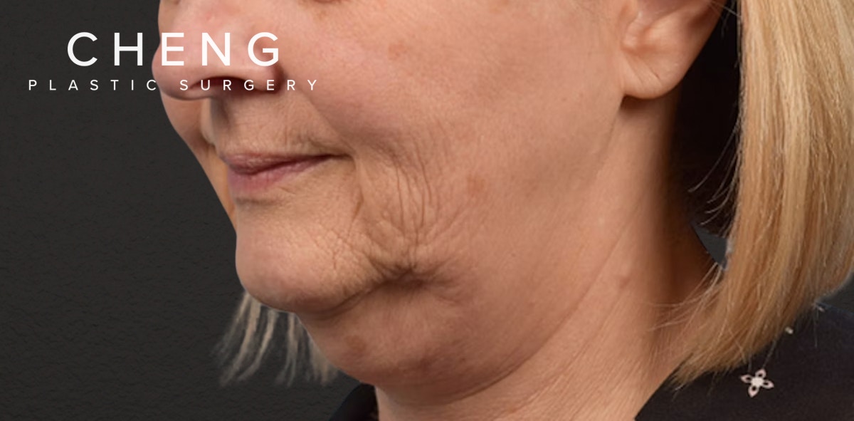 Neck Lift Before & After Gallery - Patient 350287 - Image 3