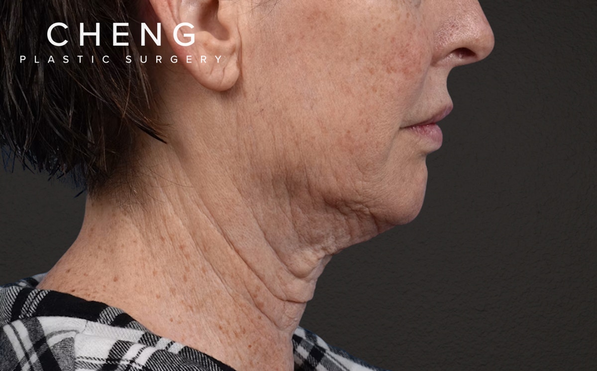 Neck Lift Before & After Gallery - Patient 238925 - Image 5
