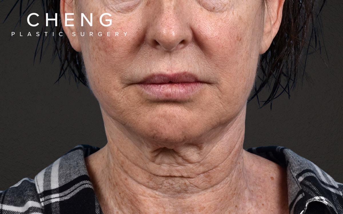 Neck Lift Before & After Gallery - Patient 238925 - Image 1