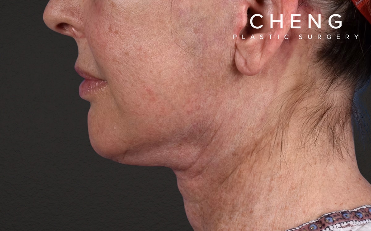 Neck Lift Before & After Gallery - Patient 238925 - Image 10