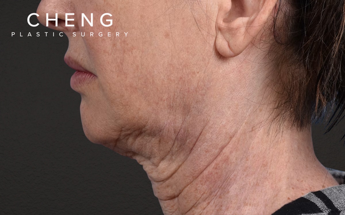 Neck Lift Before & After Gallery - Patient 238925 - Image 9