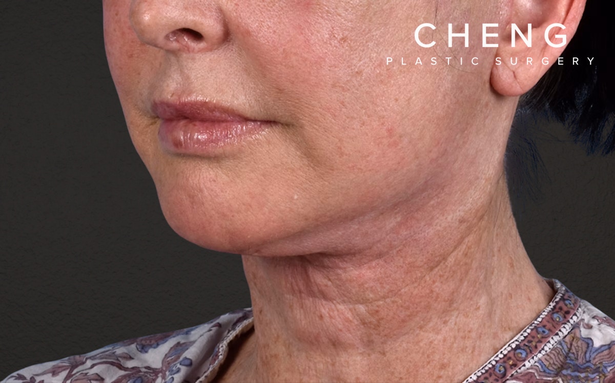 Neck Lift Before & After Gallery - Patient 238925 - Image 8
